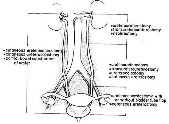 Ureteral injuries and repairs.