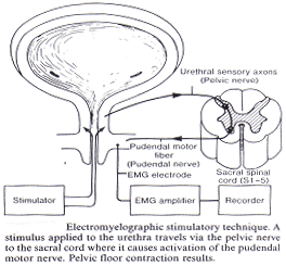 electromyelographic刺激技术。刺激适用于尿道旅行通过盆神经向骶脊髓那里的原因活化的阴部运动神经。骨盆底肌肉收缩的结果。