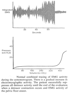 Normal combinado rastreo de la actividad EMG durante el cystometrogram. Hay un aumento gradual de la actividad electromiogrfica. El paciente con xito suprime la actividad del detrusor todos hasta el final de la evaluacin cuando una contraccin del detrusor y se produce actividad EMG del cese del suelo plvico.