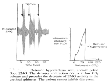 Detrusor hyperreflexia with normal pelvic floor EMG. The detrusor contraction occurs at low CO2 volume and precedes the decrease of EMG energy in the urethral sphincter. The patient cannot inhibit this event.