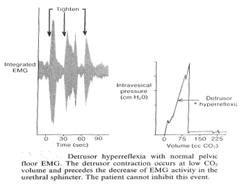 Dtrusor hyperrflexie normal EMG du plancher pelvien. Le dtrusor contraction se produit  faible volume de CO2 et prcde la diminution du GGE nergie dans le sphincter urtral. Le patient ne peut pas empcher cette manifestation.