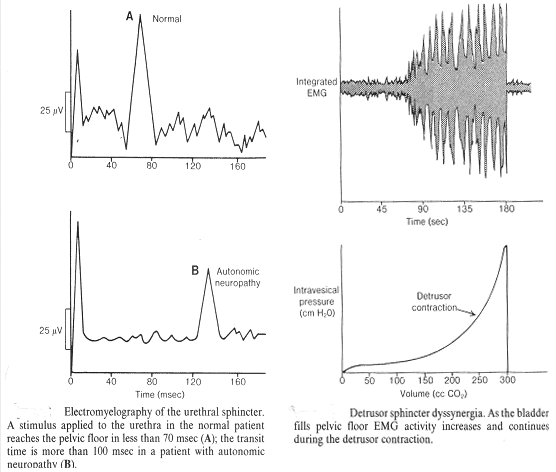 Myelography الكهرباءيه من احليلي المصره. حافزا ينطبق على مجرى البول الطبيعي في الحوض المريض تصل الكلمه في اقل من 70msec (أ) ؛ وقت العبور هو اكثر من 100msec في الاستقلال الذاتي للمريض مع الاعتلال العصبي. (ب) dyssynergia المصره detrusor. كما المثانه تملأ الحوض الكلمه فريق الادارة البيءيه ويزيد من نشاط وتواصل الانكماش خلال detrusor. (في الحق)