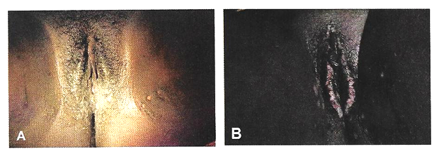 fig1_pelvic_fistulae