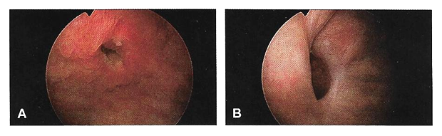 fig2_urinary_tract_fistula.png