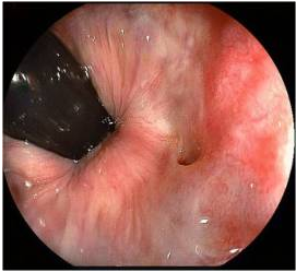 fig4_fistula_seen_in_colonoscopy271x249.png