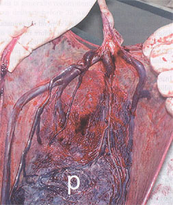 Placenta after delivery showing vasa previa. Vessels are seen running unprotected through the membranes.